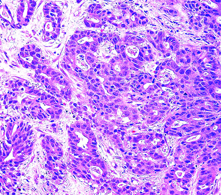 pathology-outlines-adenocarcinoma